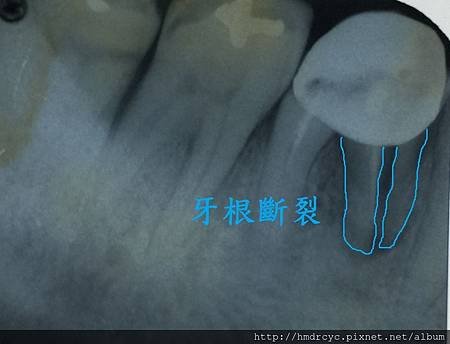 [假牙牙套] 怎麼知道假牙裡面的牙齒有沒有問題 高雄牙醫 假