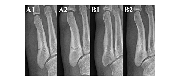 Lee-et-al-classification-of-fifth-metatarsal-stress-fracture-Group-A-complete-fracture.png