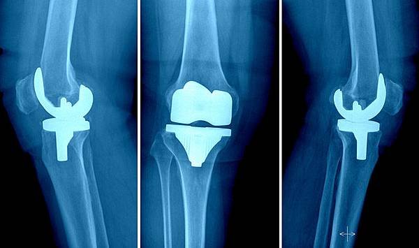 Knee-Replacement-Devices-Market.jpg