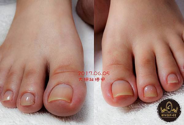 2017.06.05郭小姐大拇趾