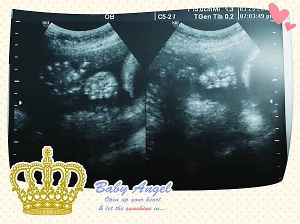 104.03.25 胎位轉正了，還給爸媽一個讚