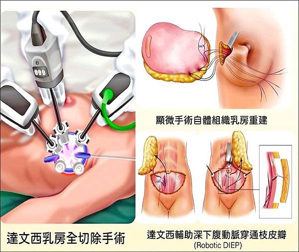 【健康新聞】57歲女健檢見乳房微鈣化 揪出原位癌