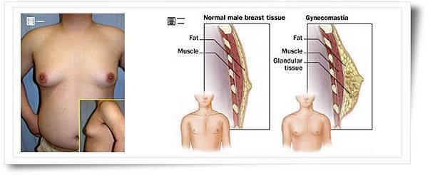 男性女乳.jpg
