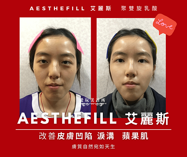 愛玩美診所艾麗斯Aesthefill精靈針.png