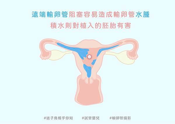 200714試管嬰兒為什麼還要做輸卵管攝影_繁-08.jpg