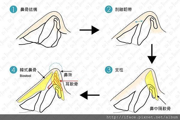 101結構隆鼻剖析