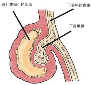 inferior T TCRF.jpg