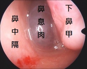 nasal polyps