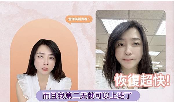 洋蔥式無痕拉皮術費用