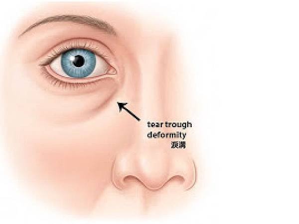 醫師專欄-鐘醫師 眼周下緣的苦惱-08.jpg