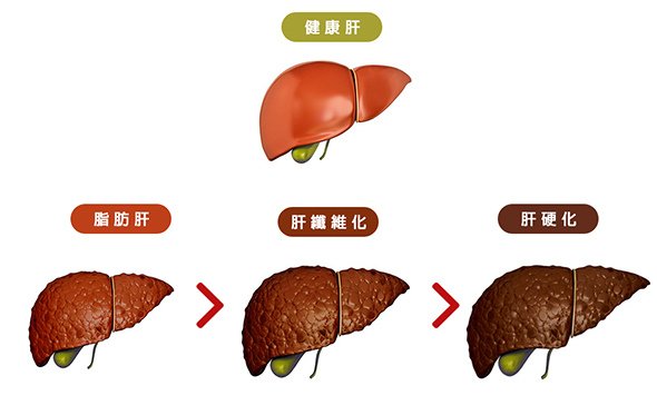 利九星 解酒 代謝 醒酒 肝硬化 脂肪肝 保健食品