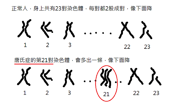 唐氏症染色體.png