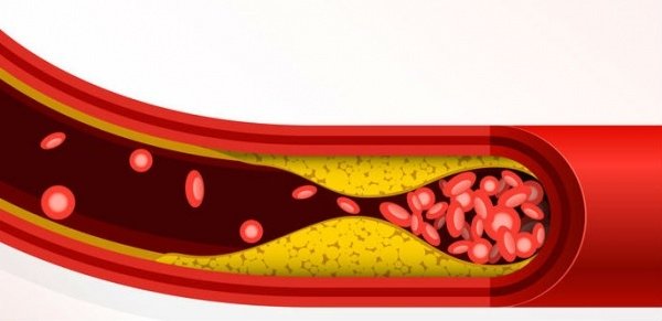 Carotid_hdl_87521258_M444.jpg