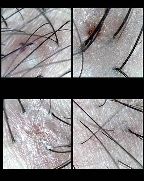 【頭皮護理知識】頭皮是讓頭髮健康生長的地基 頭皮鬆弛是臉皮老