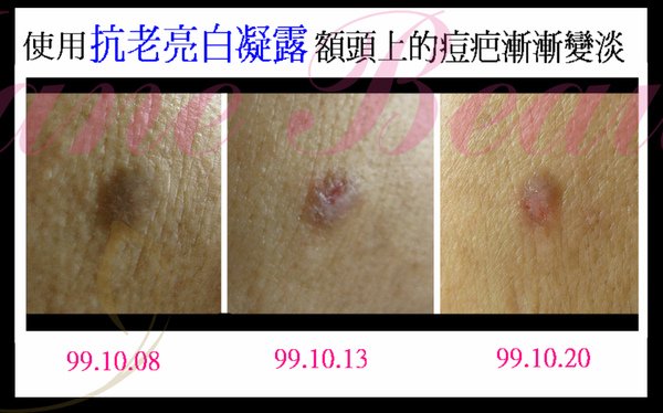 額頭痘疤比較.jpg