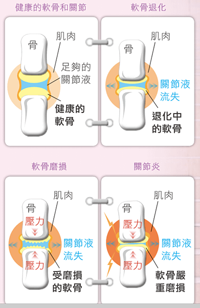 退化性關節炎