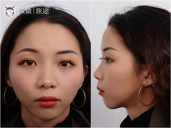 台中醫美_肉毒小臉_醫美推薦_佳思優整形外科美學診所-2.JPG