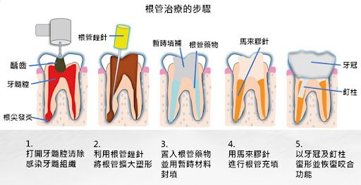 根管治療.jpg