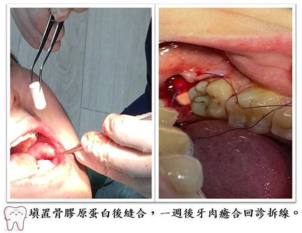 拔牙填補骨膠原蛋白.jpg