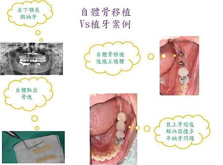 自體骨移植案例