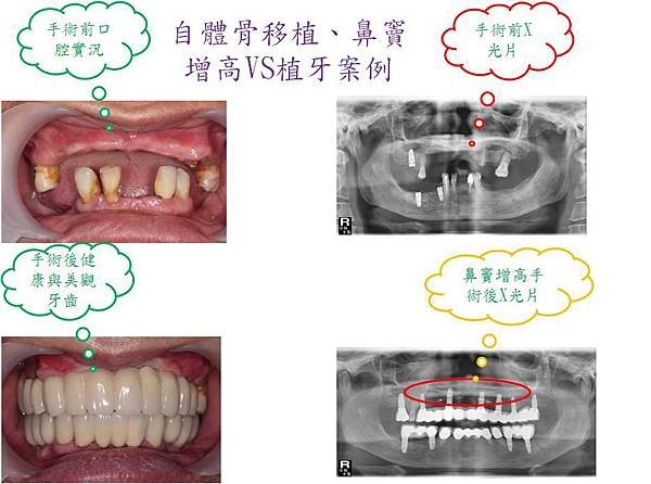 鼻竇增高自體骨移植及植牙