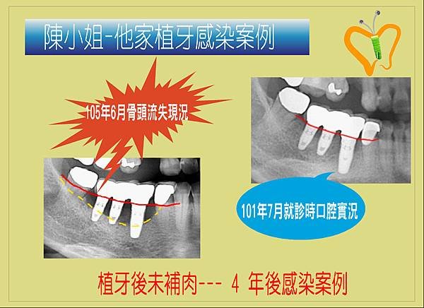 角化牙齦案例.2.JPG