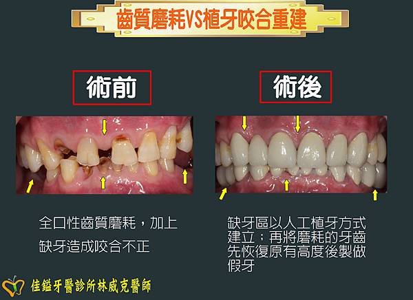 齒質磨耗VS植牙.1.JPG