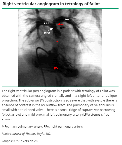 Right ventricular obstruction.png