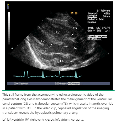 TOF echo aortic overriding.png