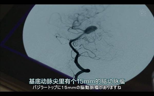 ディ・ダ・ヴィンチの診断  15mm腦動脈瘤