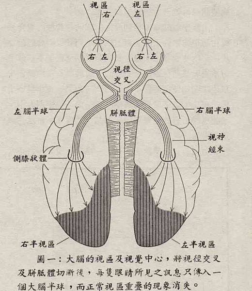 胼胝體切除術.jpg