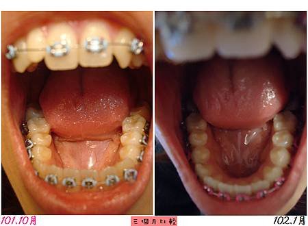 3個月張口比較