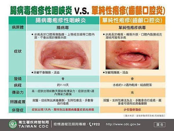 腸病毒5