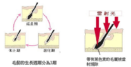 永久除毛的原理為何02