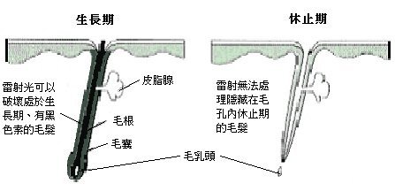 永久除毛的原理為何03