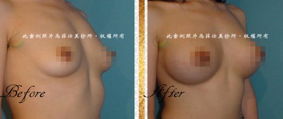 台中隆乳｜台中隆乳術後按摩11