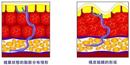 抽脂術後按摩6.jpg