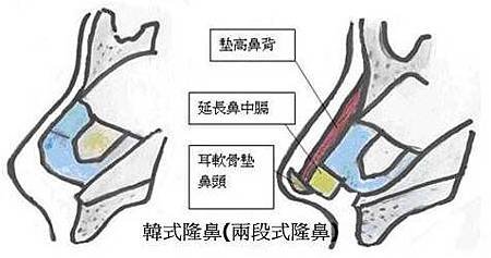 rhinoplasty-29.jpg