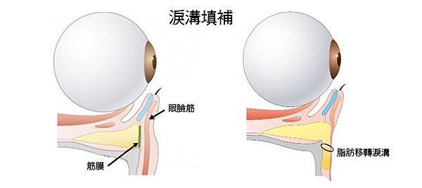 淚溝填補(1).jpg