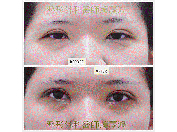 ptosis blepharo revision