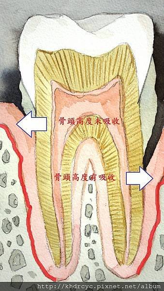 骨頭吸收