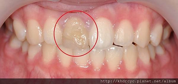 門牙變色全瓷冠4.jpg
