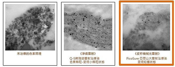 推薦 凱蒂醫美 755皮秒雷射 皮秒蜂巢透鏡 除斑 痘疤 毛孔 細紋 膠原新生 雷射除斑 效果 雷射治療 (4)