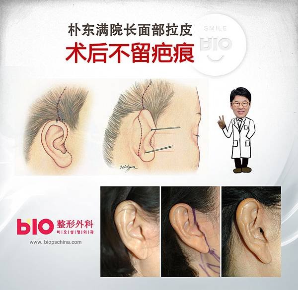 안면거상흉터 복사.jpg