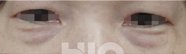 after_53101127b863a.png