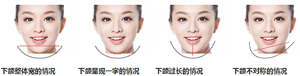 下颚角2.png