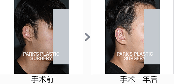 耳轮粘连症_副本.png