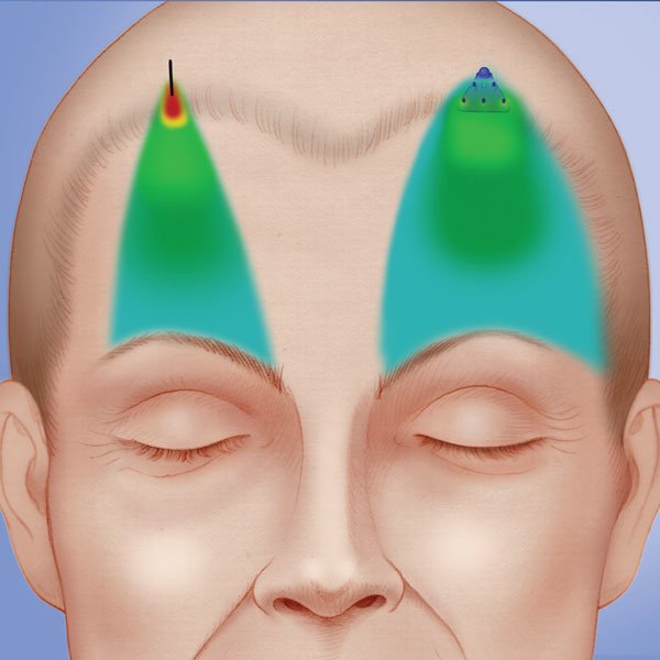 endotine-vs-suture.jpg