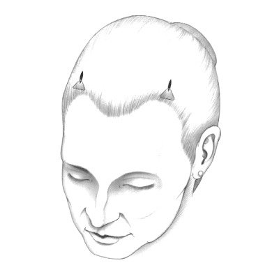 endotine-forehead-illustration.jpg