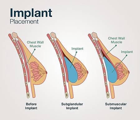 implant-placement.jpg